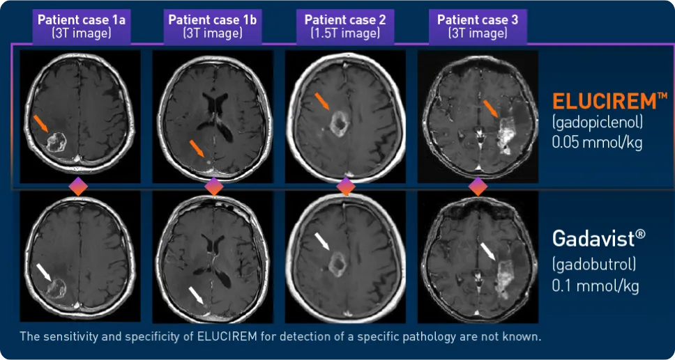 Brain and Central Nervous System (CNS) MRI